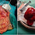 Successful Operation Tumor