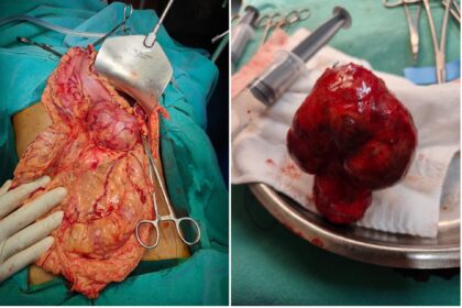 Successful Operation Tumor