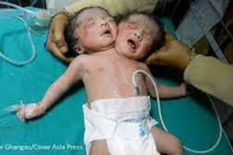 Parapagus Dicephalus Twins India