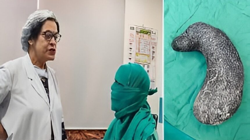 Trichophagia Rare Medical Case