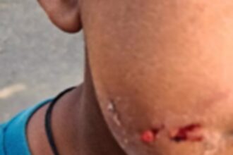 Stray Dog Attack India