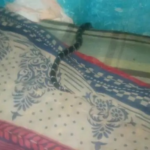 Krait Snake Bite