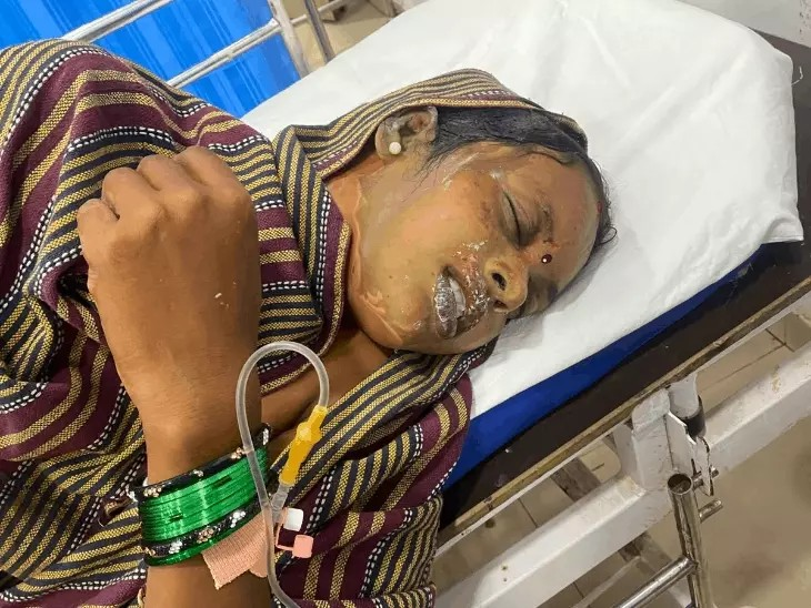 Durg Acid Attack